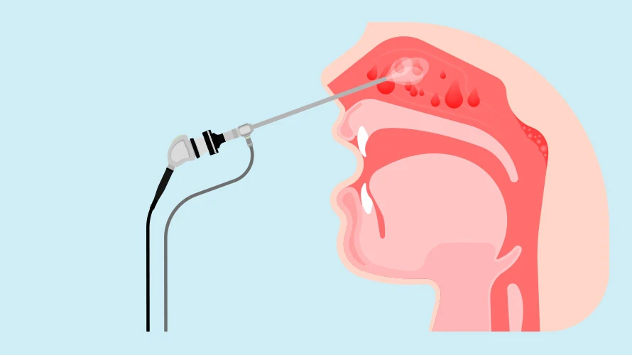 Laryngolog - usunięcie polipów nosa